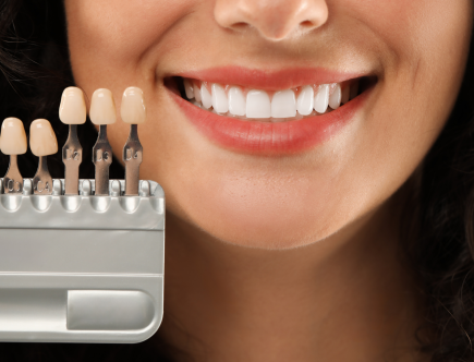 Tout savoir sur les facettes dentaires : esthétisme, pose et bénéfices